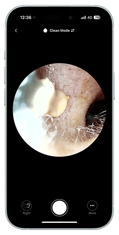 Close-up view of an ear canal with wax removal tool, displayed on a mobile screen.