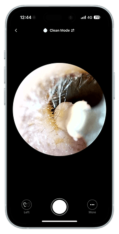 A close-up view of an ear canal displayed on a phone screen, showing wax and hair.