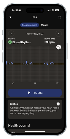 ECG reading on a smartphone showing sinus rhythm and heart rate of 69 bpm.