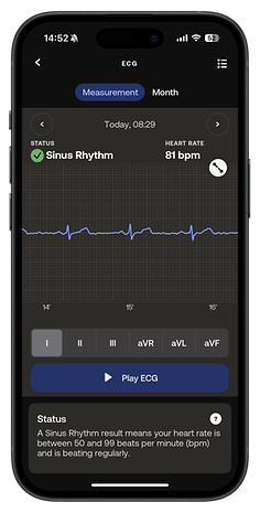 An ECG reading showing sinus rhythm with a heart rate of 81 bpm on a mobile device.