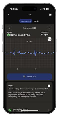 EKG-Aufzeichnung von der Withings ScanWatch Nova, die einen normalen Sinusrhythmus und eine Herzfrequenz von 50 bpm zeigt.